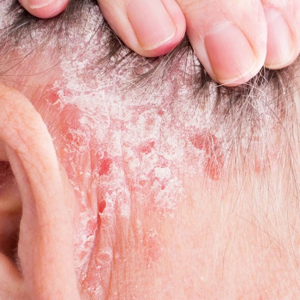 Psoriasis behind ear 